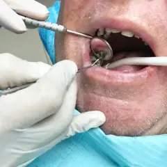 Dentysta usuwa korzeń zęba z ropą, używając lusterka i narzędzi.