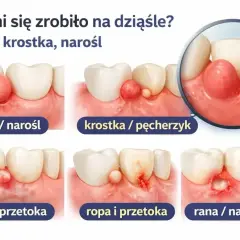 Ilustracja pokazuje różne zmiany na dziąśle: guzek, krostkę, ropę i przetokę, a także ranę. Cysta na dziąśle może przybierać różne formy.