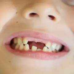 Uśmiech dziecka z widocznymi ubytkami w uzębieniu. Widać, że wypadły już pierwsze zęby mleczne, a na ich miejsce czekają nowe.