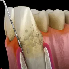Narzędzie dentystyczne usuwa kamień nazębny z korony zęba i linii dziąseł.