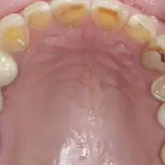 Jak bezpiecznie zatkać dziurę w zębie? Tymczasowe sposoby na ulgę przed dentystą