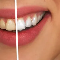 Jak wybielić zęby u dentysty – metody, efekty i co musisz wiedzieć przed zabiegiem