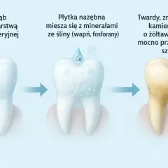 Jak wygląda kamień na zębach: od czystego zęba, przez płytkę nazębną mieszającą się z minerałami, aż do twardego, żółtawego kamienia mocno przylegającego do szkliwa.