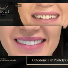 Przed i po: uśmiech po zabiegu piłowania zębów. Piękne, białe zęby po korekcie.