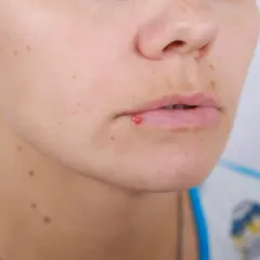 Czy z opryszczką można iść do dentysty? Ryzyka i zalecenia przed wizytą