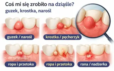 Ilustracja pokazuje różne zmiany na dziąśle: guzek, krostkę, ropę i przetokę, a także ranę. Cysta na dziąśle może przybierać różne formy.