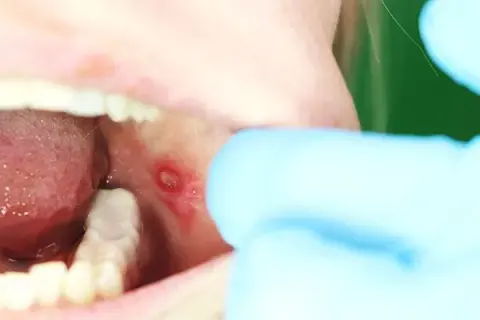 Czy z aftą można iść do dentysty? Sprawdź, czy to bezpieczne i co warto wiedzieć