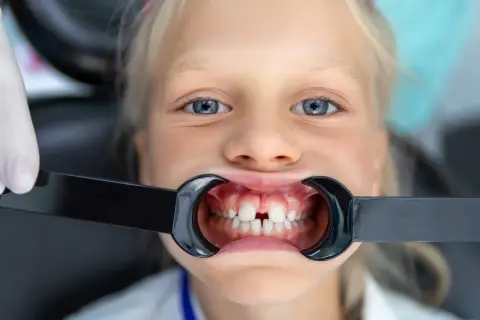 Uśmiechnięta dziewczynka z niebieskimi oczami, u której widoczna jest diastema u dzieci. W ustach ma rozwierak dentystyczny.