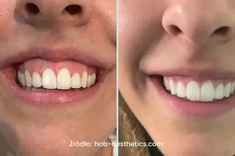 Uśmiech przed i po zabiegu botoksu na gummy smile. Widoczna różnica w odsłanianiu dziąseł.