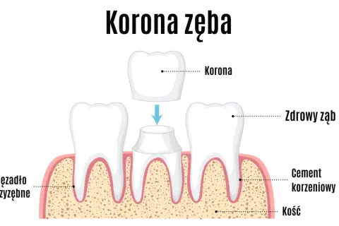 Ilustracja pokazuje proces zakładania korony na ząb. Dwa zdrowe zęby po bokach, a w środku ząb przygotowany do założenia korony, która jest umieszczona nad nim.