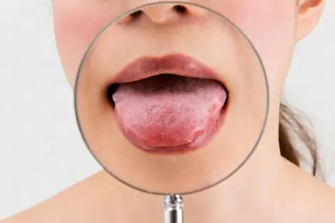 Jak wygląda rak jamy ustnej? Zdjęcia, objawy i kiedy udać się do lekarza
