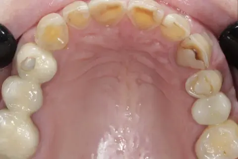 Jak bezpiecznie zatkać dziurę w zębie? Tymczasowe sposoby na ulgę przed dentystą