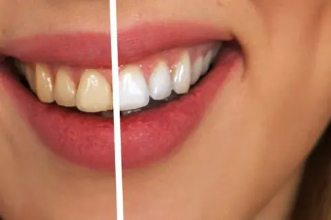 Jak wybielić zęby u dentysty – metody, efekty i co musisz wiedzieć przed zabiegiem