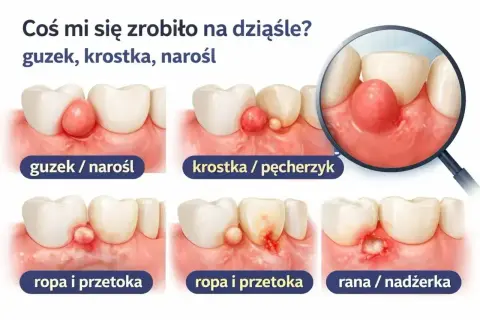 Zmiany na dziąśle: guzek, krostka, narośl, ropa, przetoka, rana. Ilustracje pokazują różne stany zapalne błony śluzowej jamy ustnej.