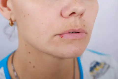 Czy z opryszczką można iść do dentysty? Ryzyka i zalecenia przed wizytą