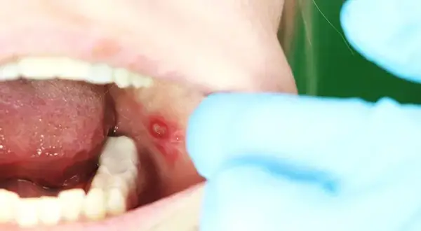 Czy z aftą można iść do dentysty? Sprawdź, czy to bezpieczne i co warto wiedzieć