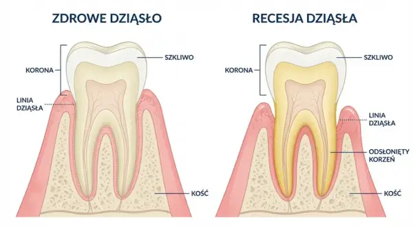 Zdrowe dziąsło vs. recesja dziąsła. Ilustracja pokazuje odsłonięty korzeń zęba, co może prowadzić do nadwrażliwości dziąseł.