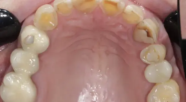Jak bezpiecznie zatkać dziurę w zębie? Tymczasowe sposoby na ulgę przed dentystą