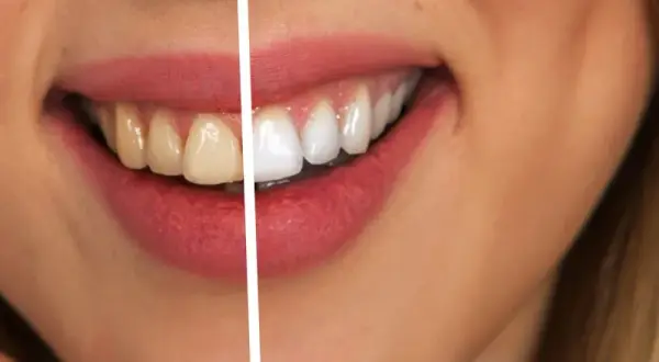 Jak wybielić zęby u dentysty – metody, efekty i co musisz wiedzieć przed zabiegiem