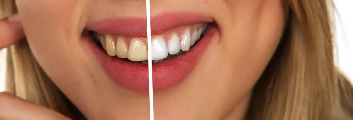 Jak wybielić zęby u dentysty – metody, efekty i co musisz wiedzieć przed zabiegiem