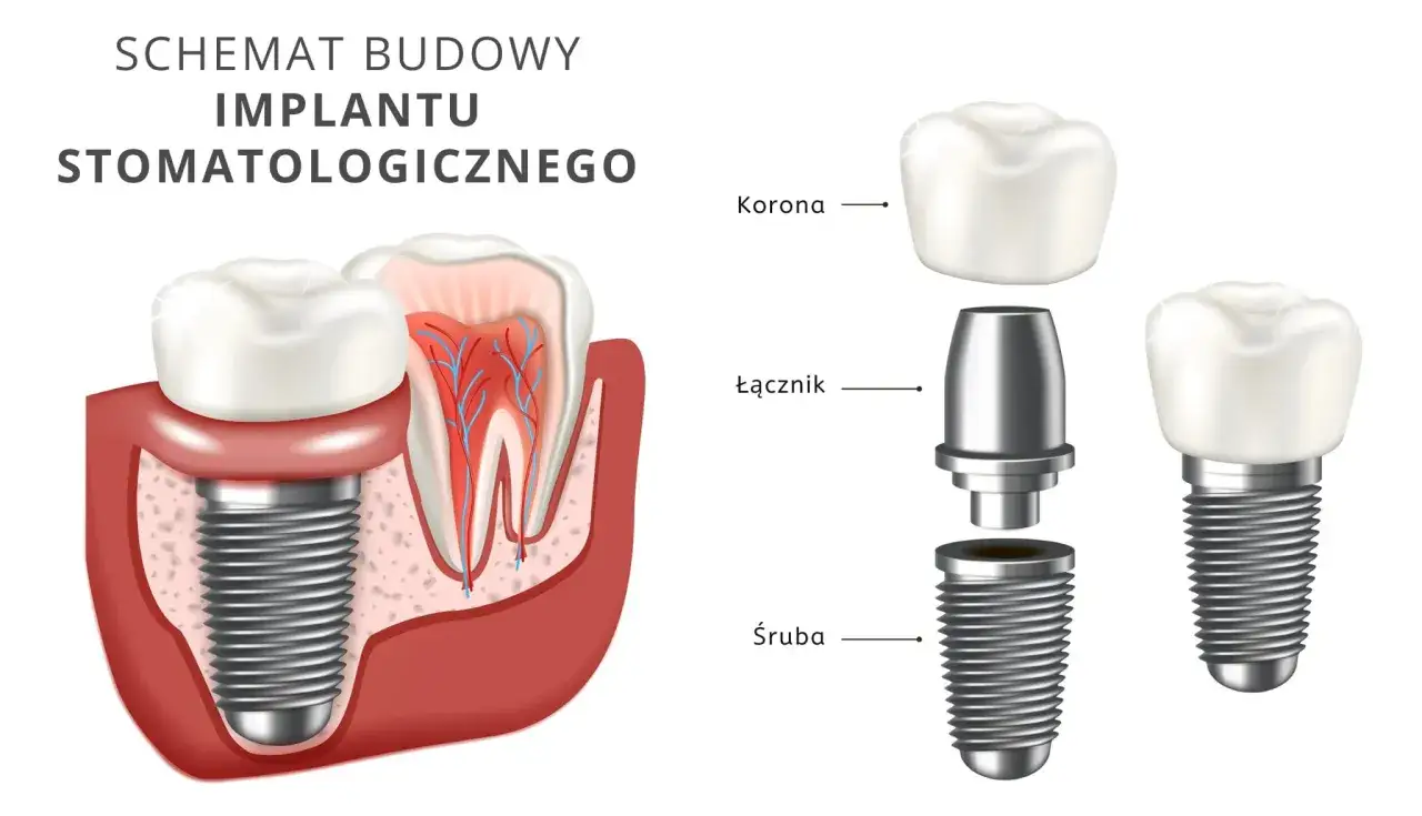 Schemat budowy implantu stomatologicznego: korona, łącznik i śruba. Zastanawiasz się, ile kosztuje korona zęba na implancie?