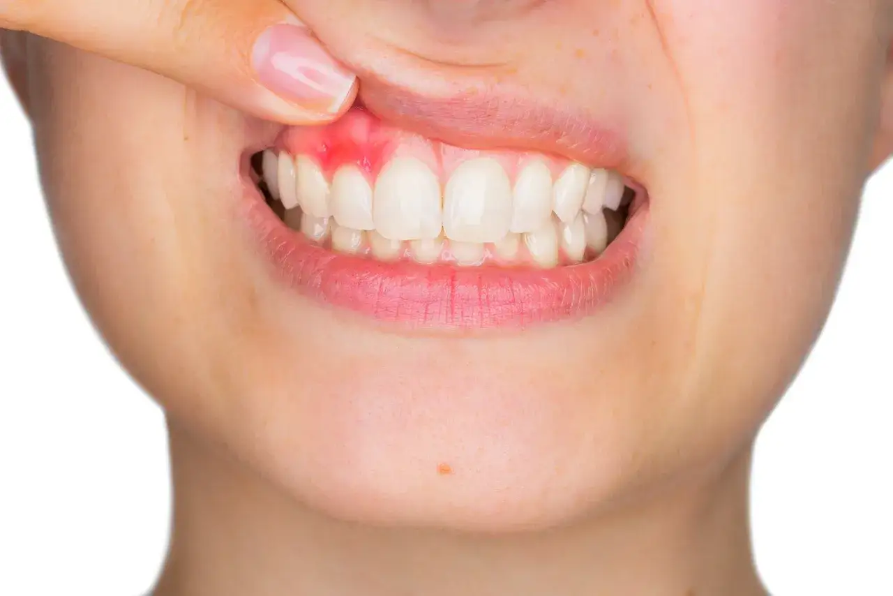 Zapalenie dziąseł (gingivitis) objawia się zaczerwienieniem i obrzękiem dziąseł, widoczne na zbliżeniu uśmiechu.