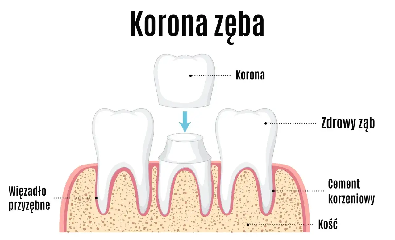 Ilustracja pokazuje proces zakładania korony na ząb. Zastanawiasz się, ile kosztuje korona zęba?