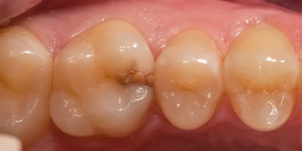 Zdjęcie Jak bezpiecznie zatkać dziurę w zębie? Tymczasowe sposoby na ulgę przed dentystą