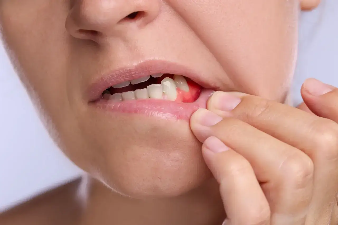 Czerwone, opuchnięte dziąsło przy zębach, wskazujące na zapalenie dziąseł (gingivitis).