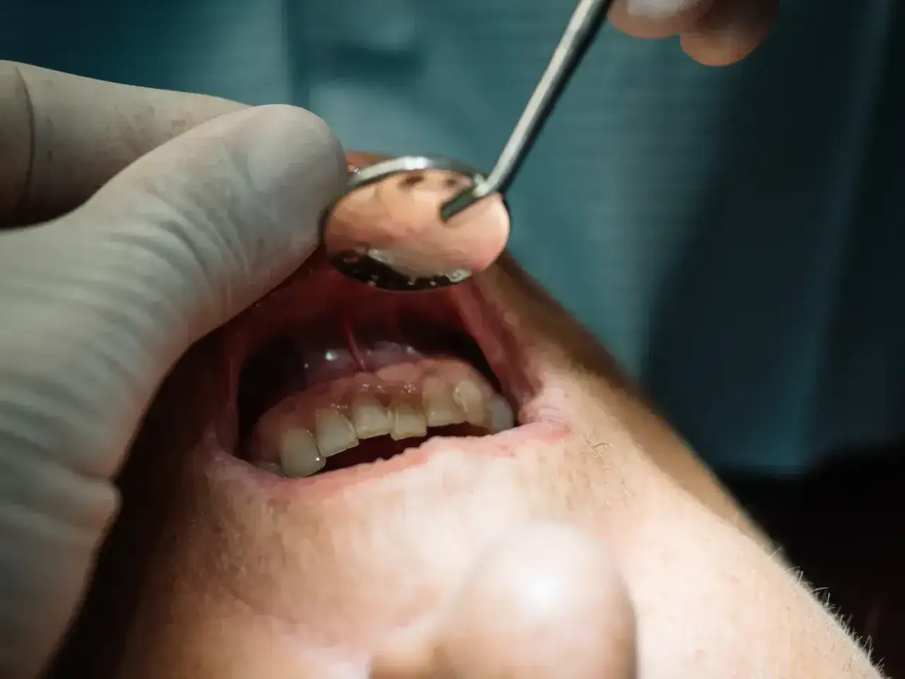 Dentysta w białej rękawiczce używa lusterka do oceny stanu jamy ustnej, przygotowując się do usuwania korzenia zęba z ropą.