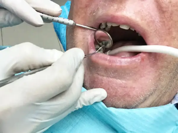 Dentysta usuwa korzeń zęba z ropą, używając lusterka i narzędzi.