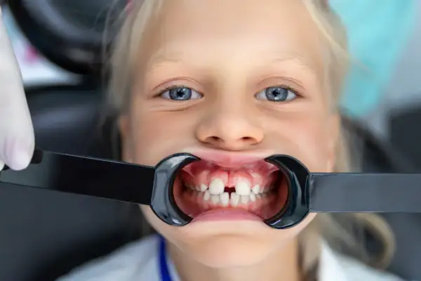 Uśmiechnięta dziewczynka z niebieskimi oczami, u której widoczna jest diastema u dzieci. W ustach ma rozwierak dentystyczny.
