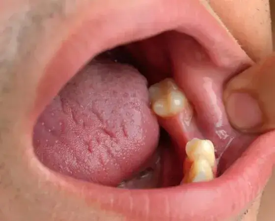 Jak powinno wyglądać dziąsło po wyrwaniu zęba? Ostrzeżenia i porady dla prawidłowego gojenia