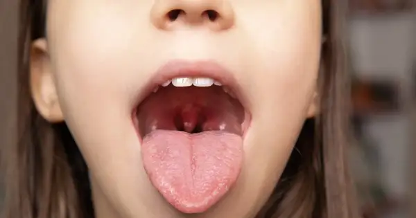Dziecko pokazuje otwarte usta z widocznymi czerwonymi plamami na podniebieniu i językiem.