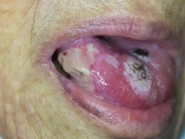 Widoczna narośl pod językiem, z białymi i czerwonymi zmianami, wymaga konsultacji lekarskiej.
