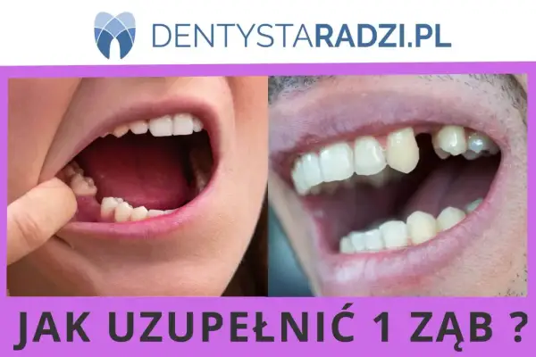 Widoczne ubytki zębów, jeden z nich jest widocznie brakujący. Pytanie brzmi: "Jak uzupełnić 1 ząb?".