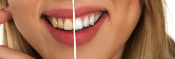 Jak wybielić zęby u dentysty – metody, efekty i co musisz wiedzieć przed zabiegiem